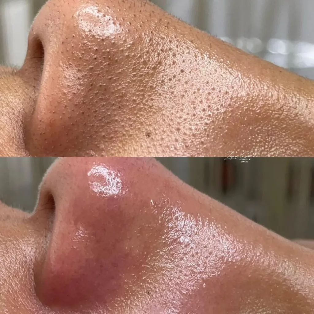 Hydrafacial Before and After