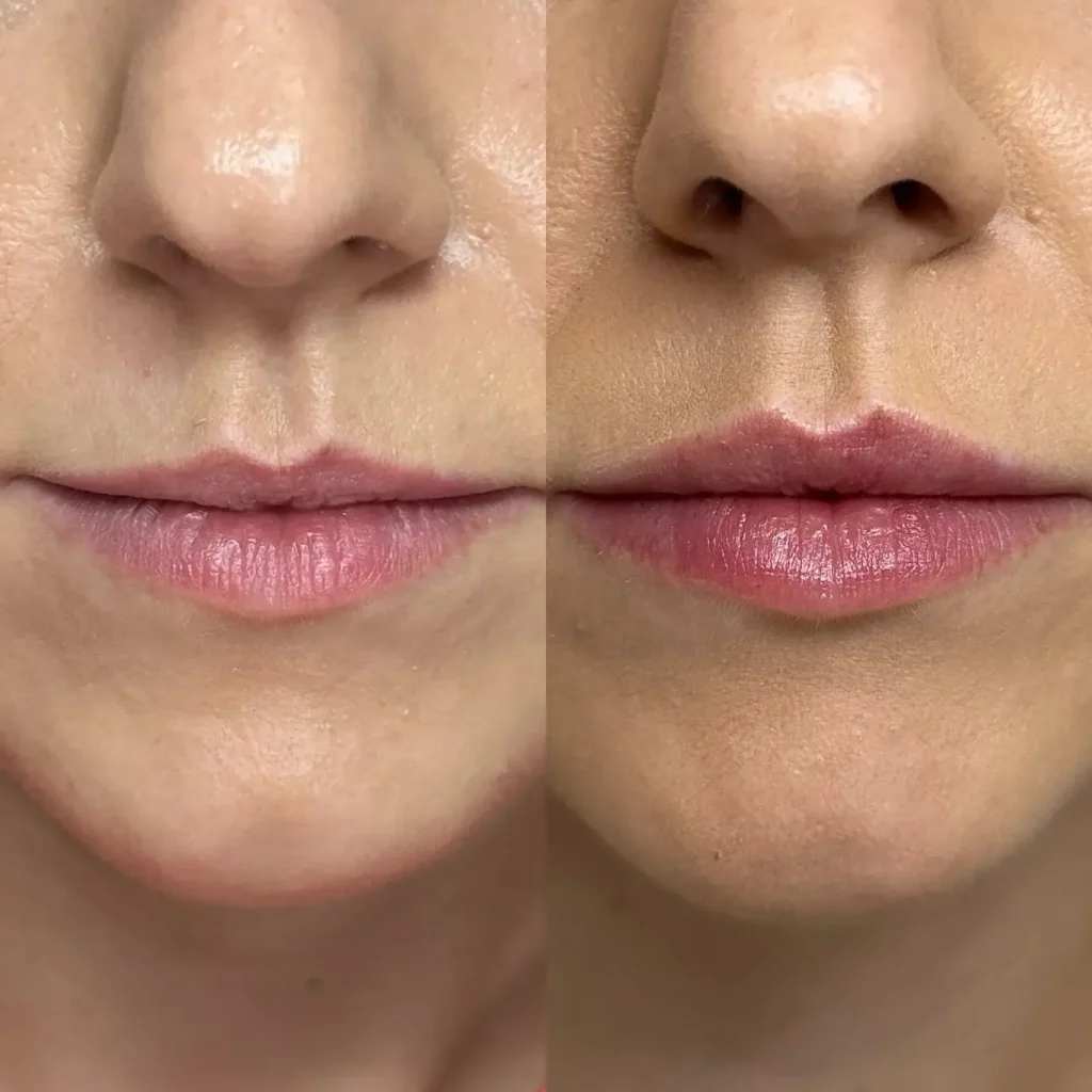 Lip Flip Before and After