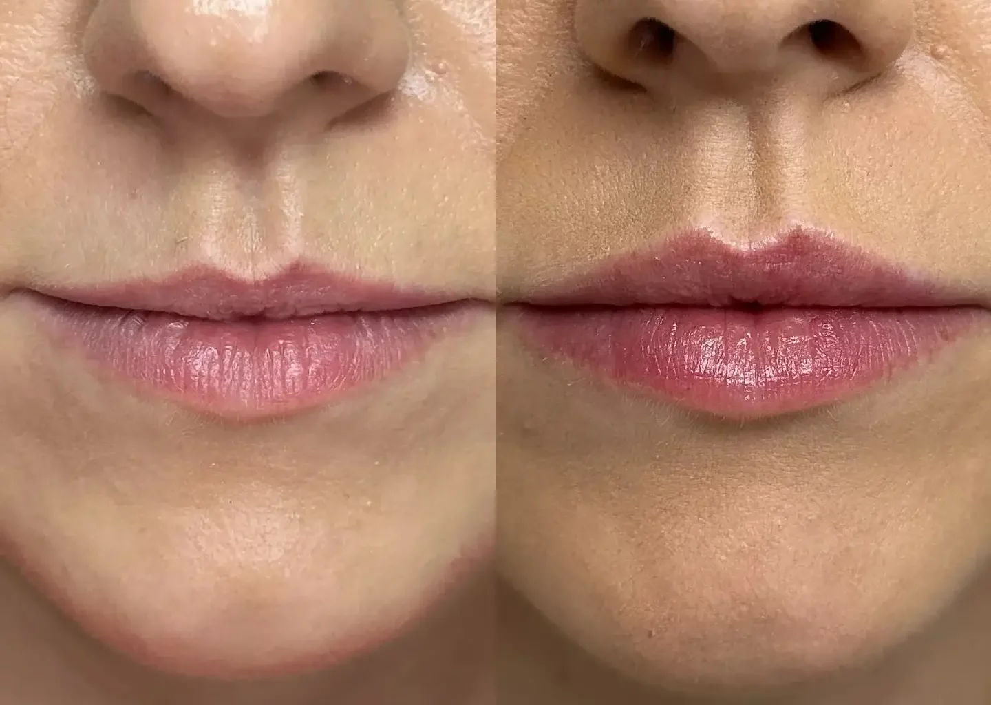 Lip Flip Before and After