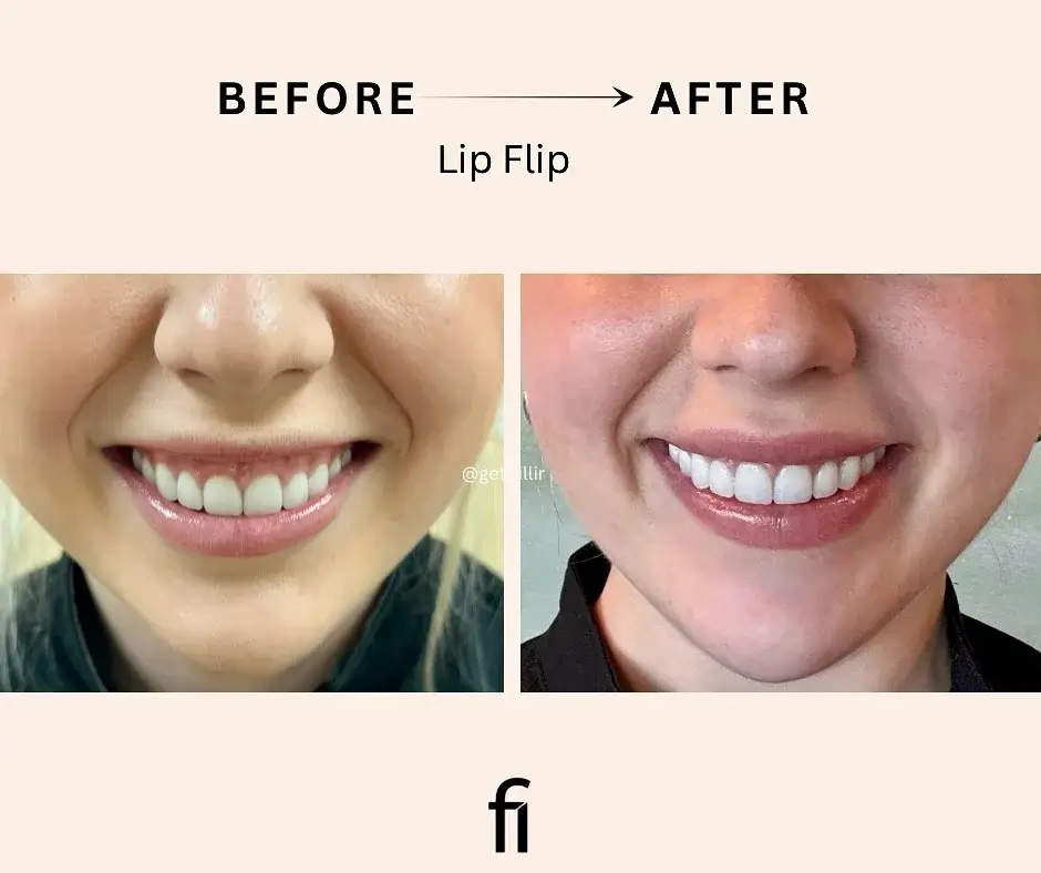 Lip Flip Before and After