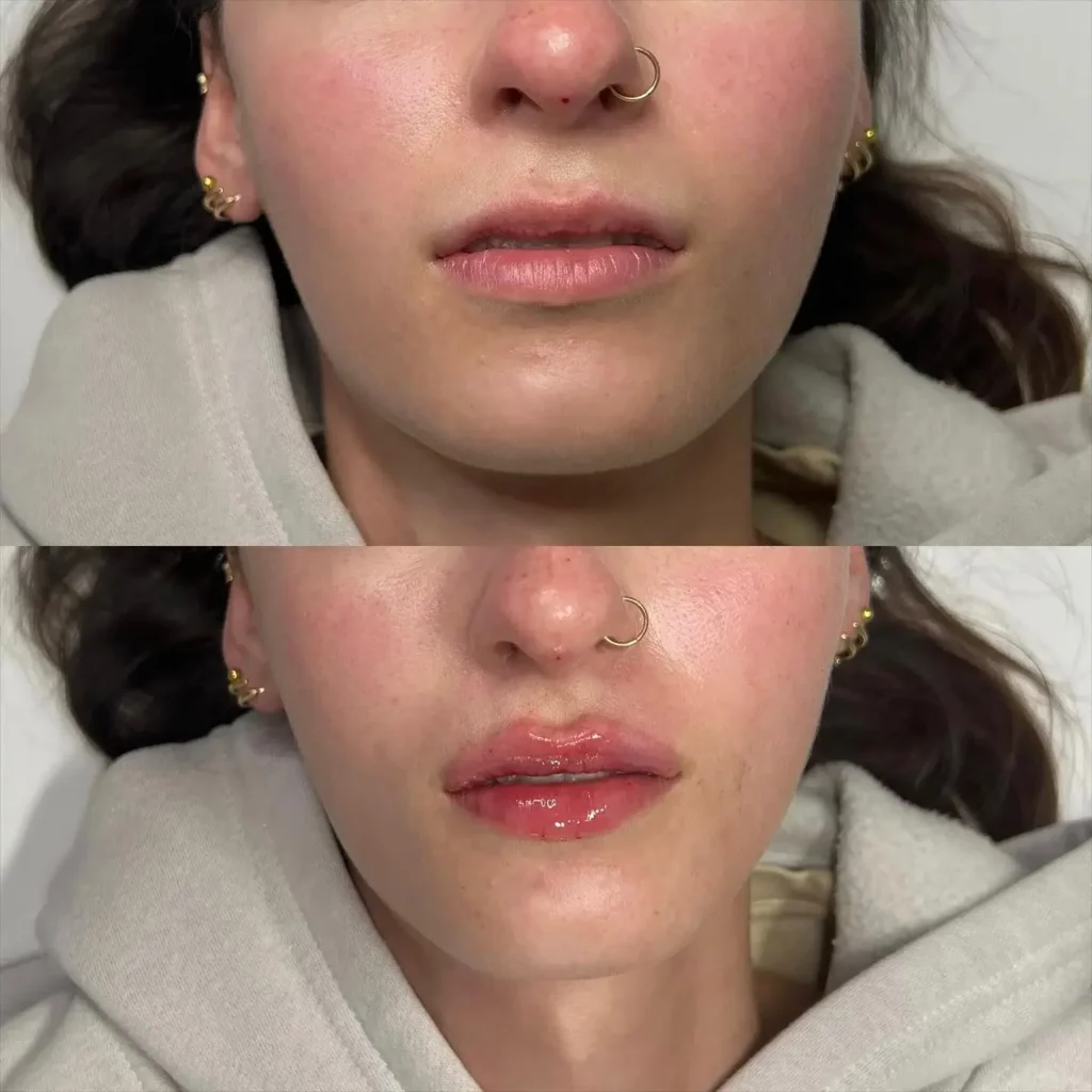 Lip Flip Before and After