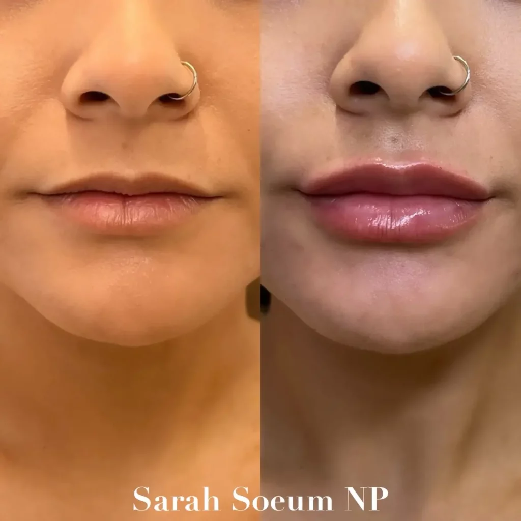 Lip Flip Before and After