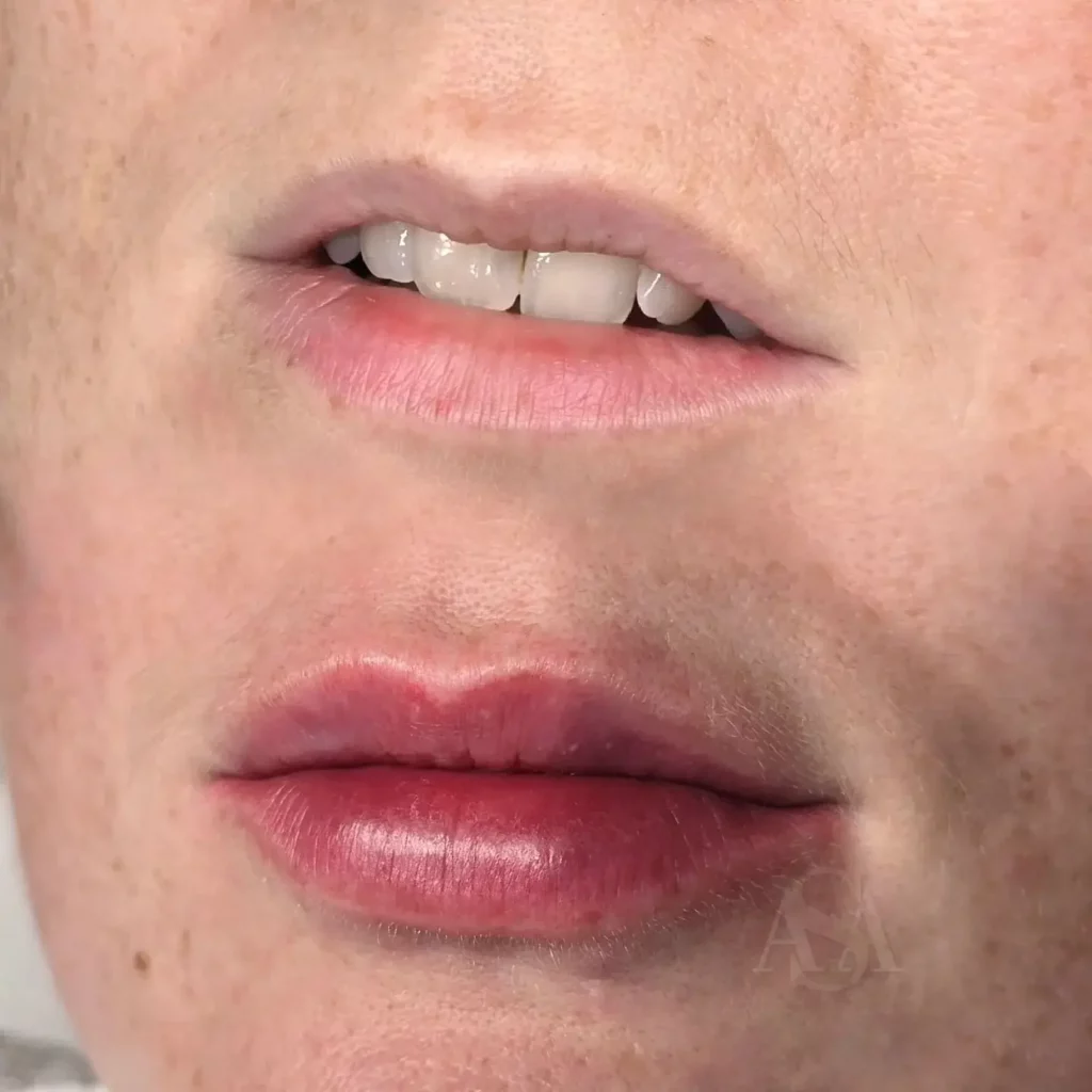 Lip Flip Before and After