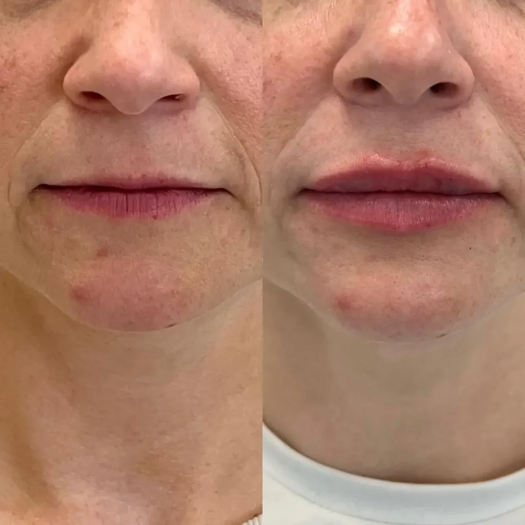 Lip Flip Before and After