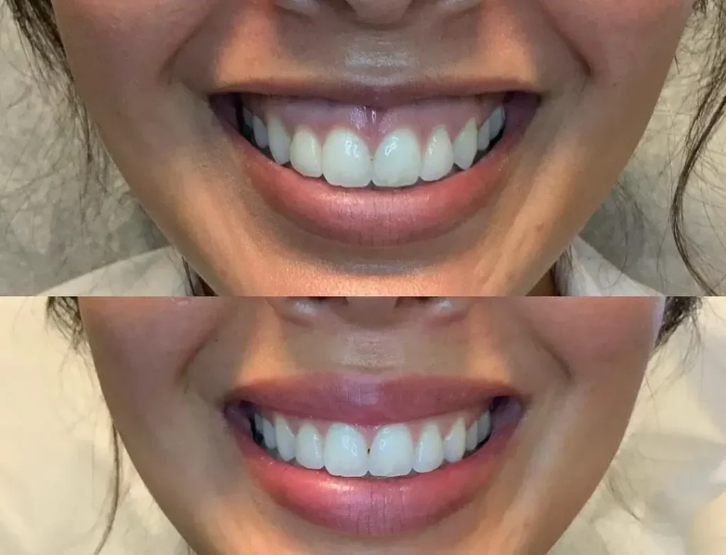 Lip Flip Before and After