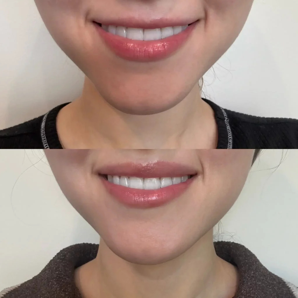 Lip Flip Before and After