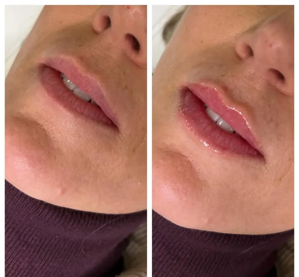 Lip Flip Before and After