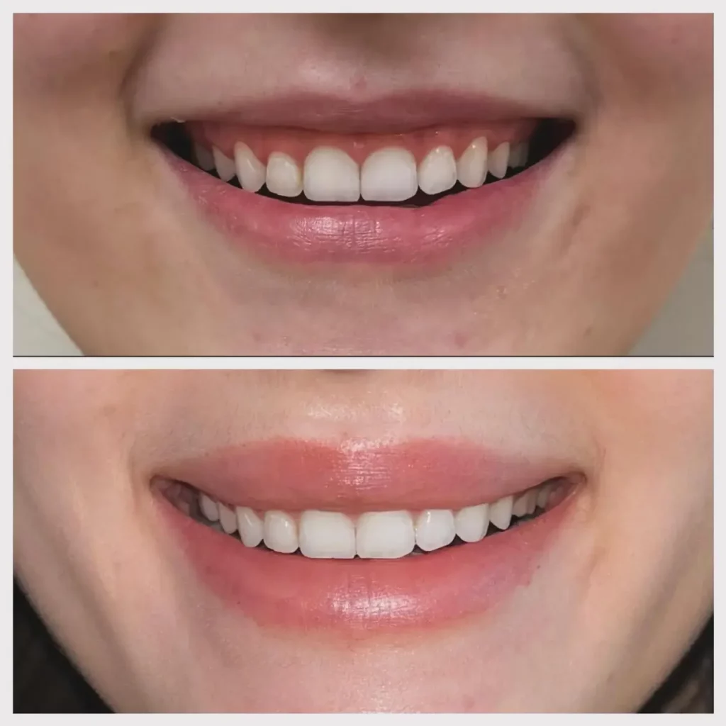 Lip Flip Before and After