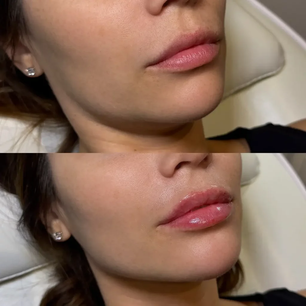 Lip Flip Before and After