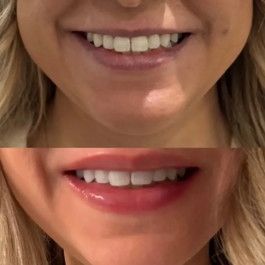 Lip Flip Before and After