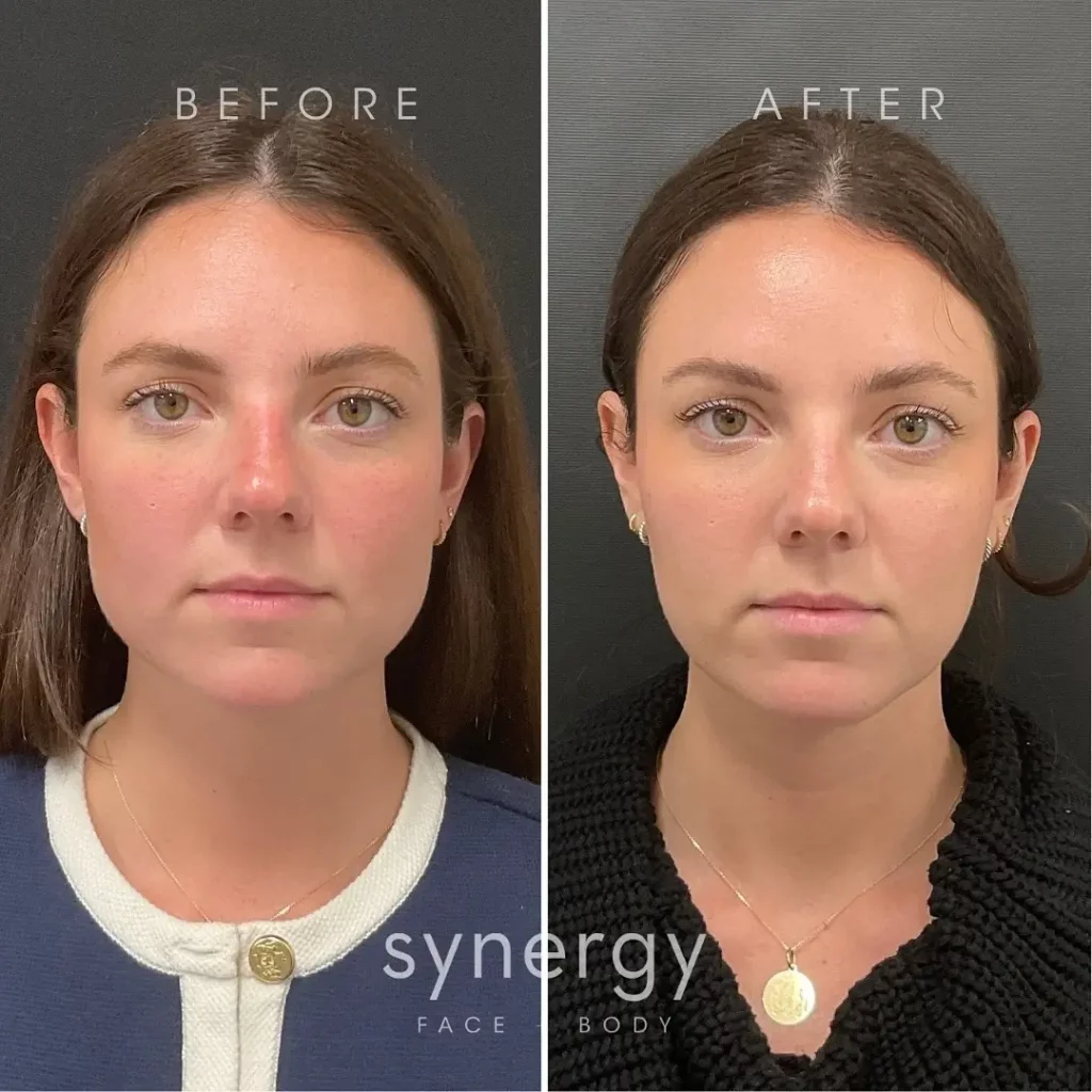 Masseter botox before and after