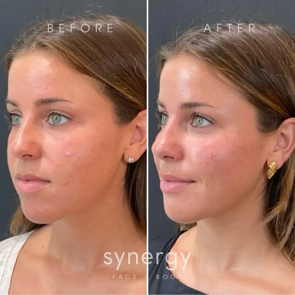 Masseter Botox Before And After Before After Journey Masseter Botox Before And After Before After Journey