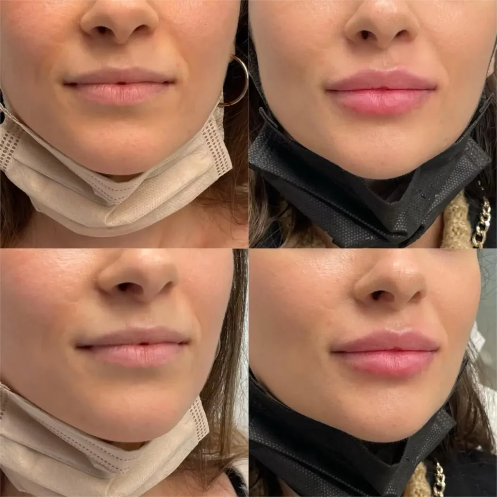 Masseter botox before and after