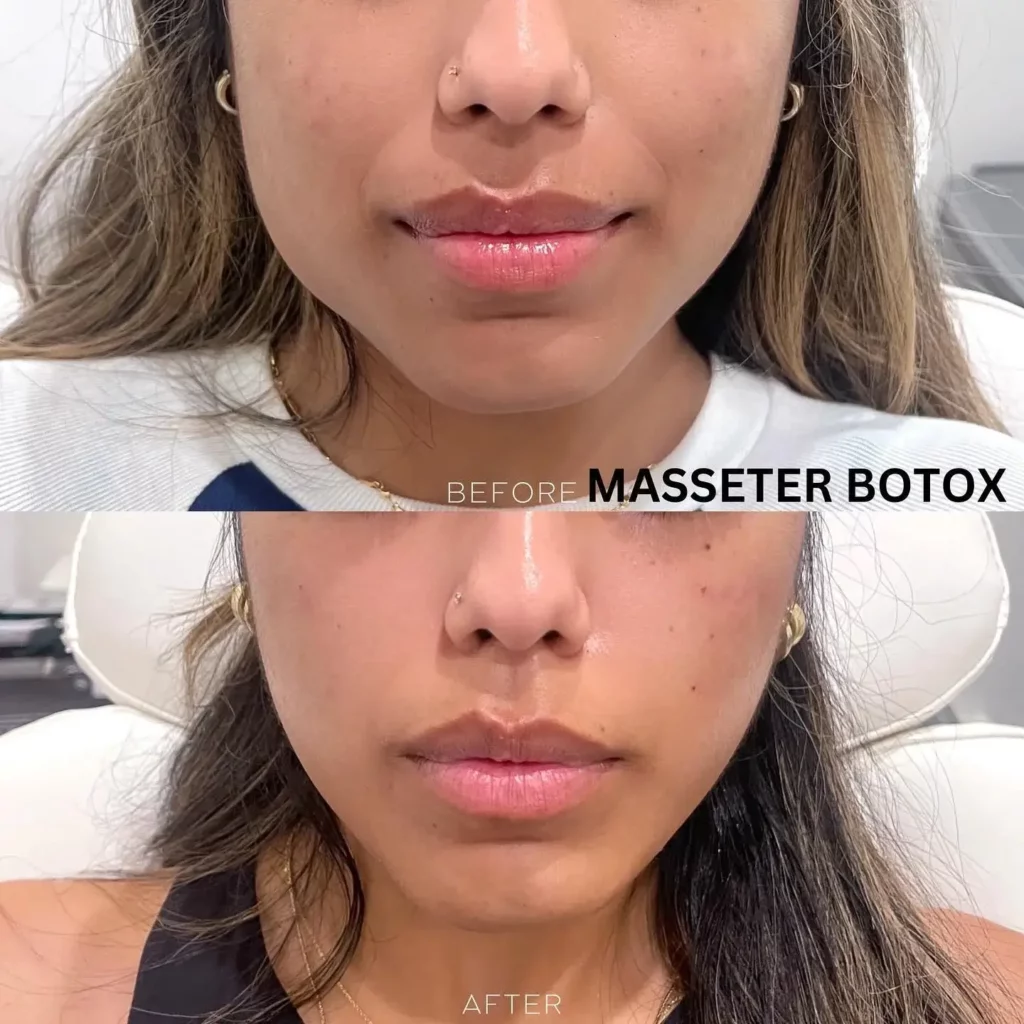 Masseter botox before and after