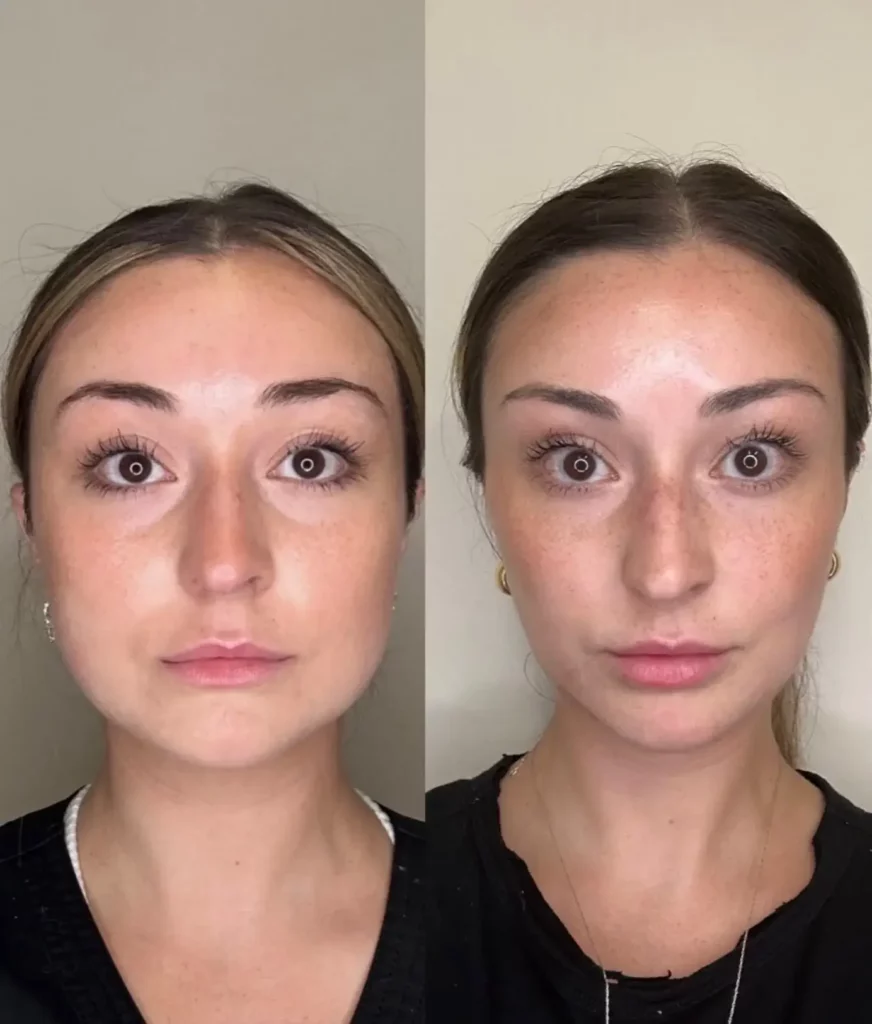 Masseter botox before and after