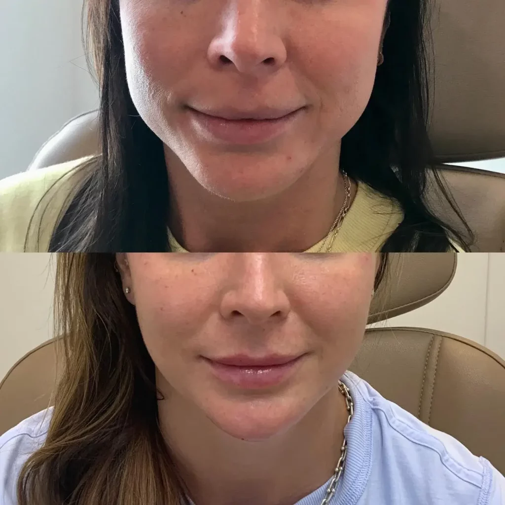 Masseter botox before and after