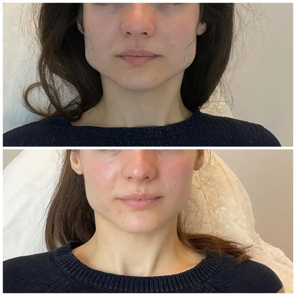 Masseter botox before and after