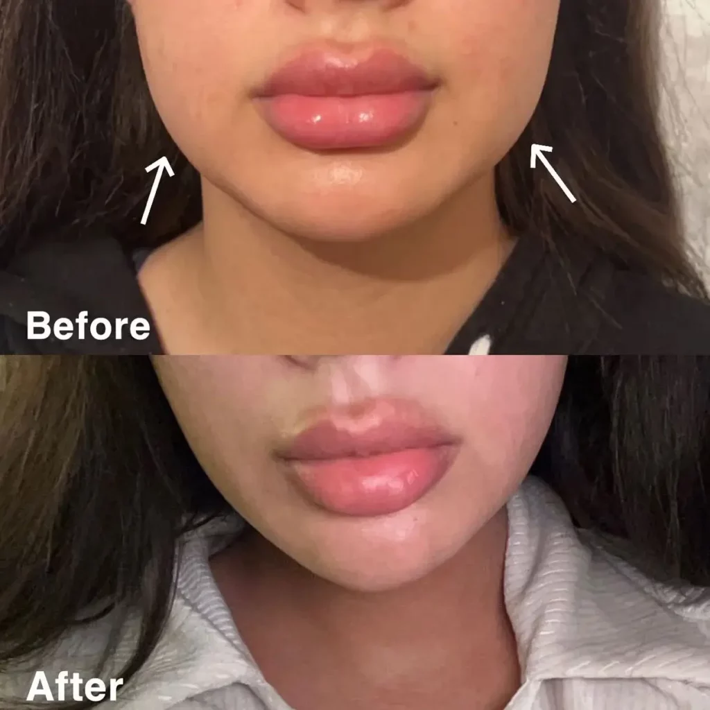 Masseter botox before and after