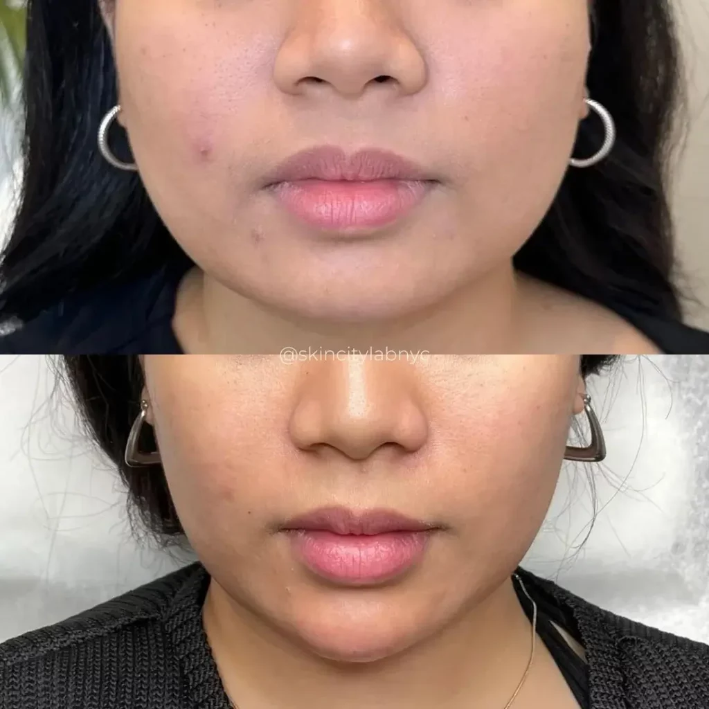 Masseter botox before and after