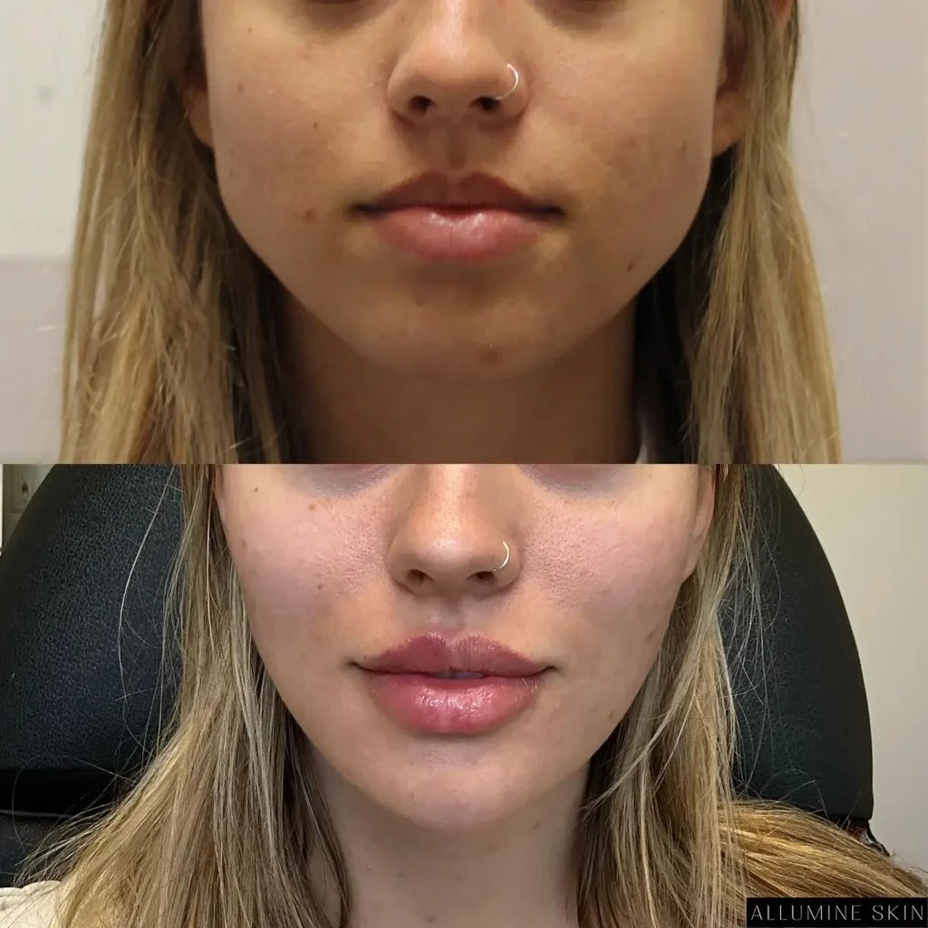 Masseter botox before and after