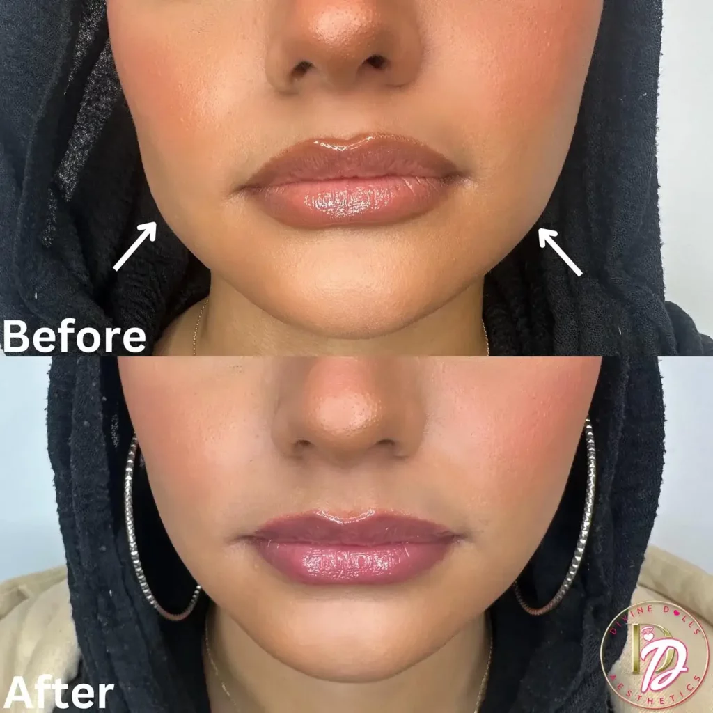 Masseter botox before and after