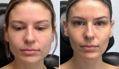 Masseter botox before and after