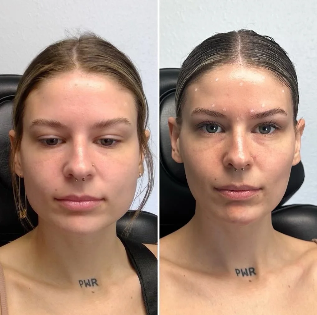 Masseter botox before and after