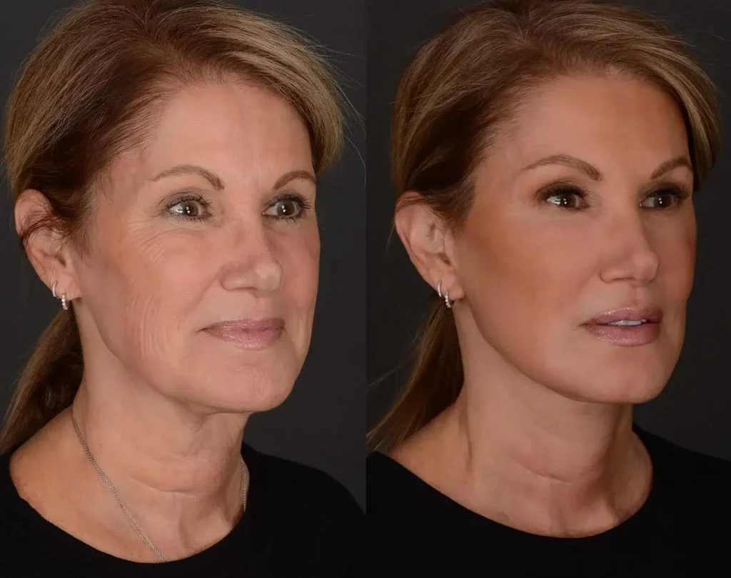 Neck Lift Before and After