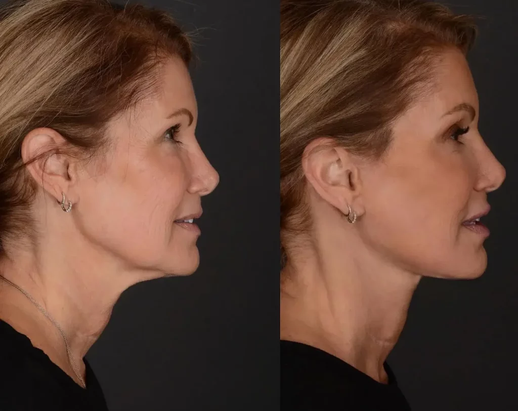 Neck Lift Before and After