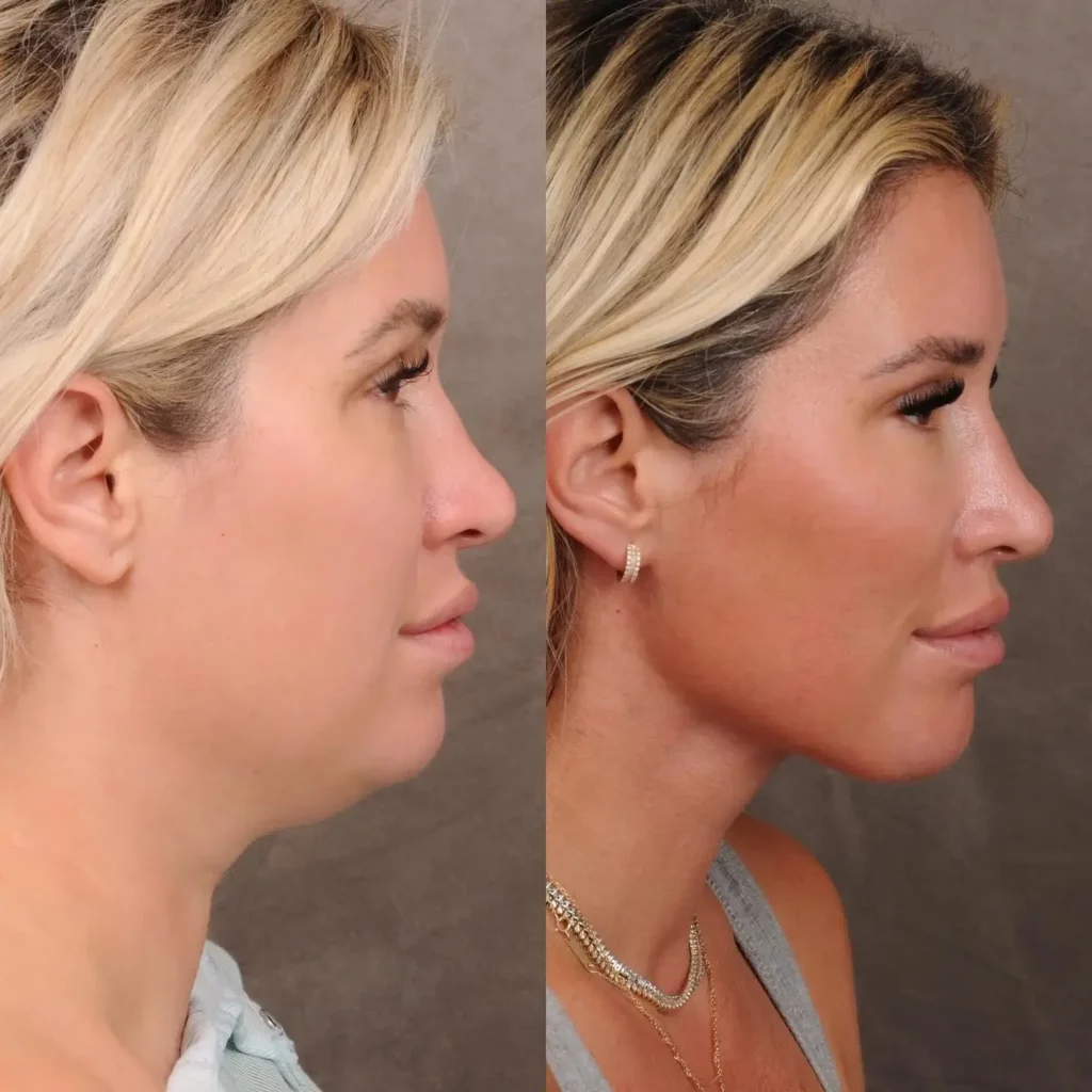 Neck Lift Before and After