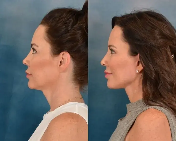 Neck Lift Before and After