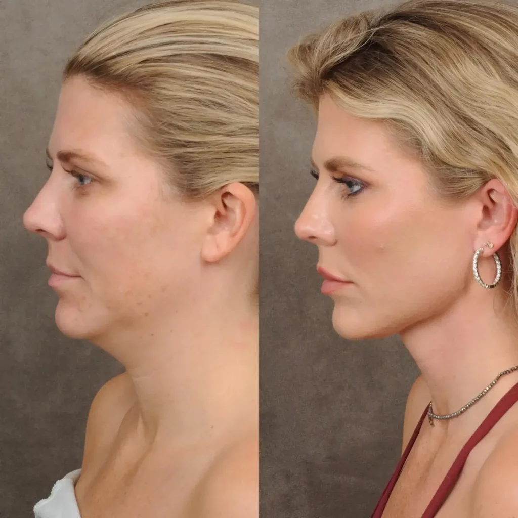 Neck Lift Before and After