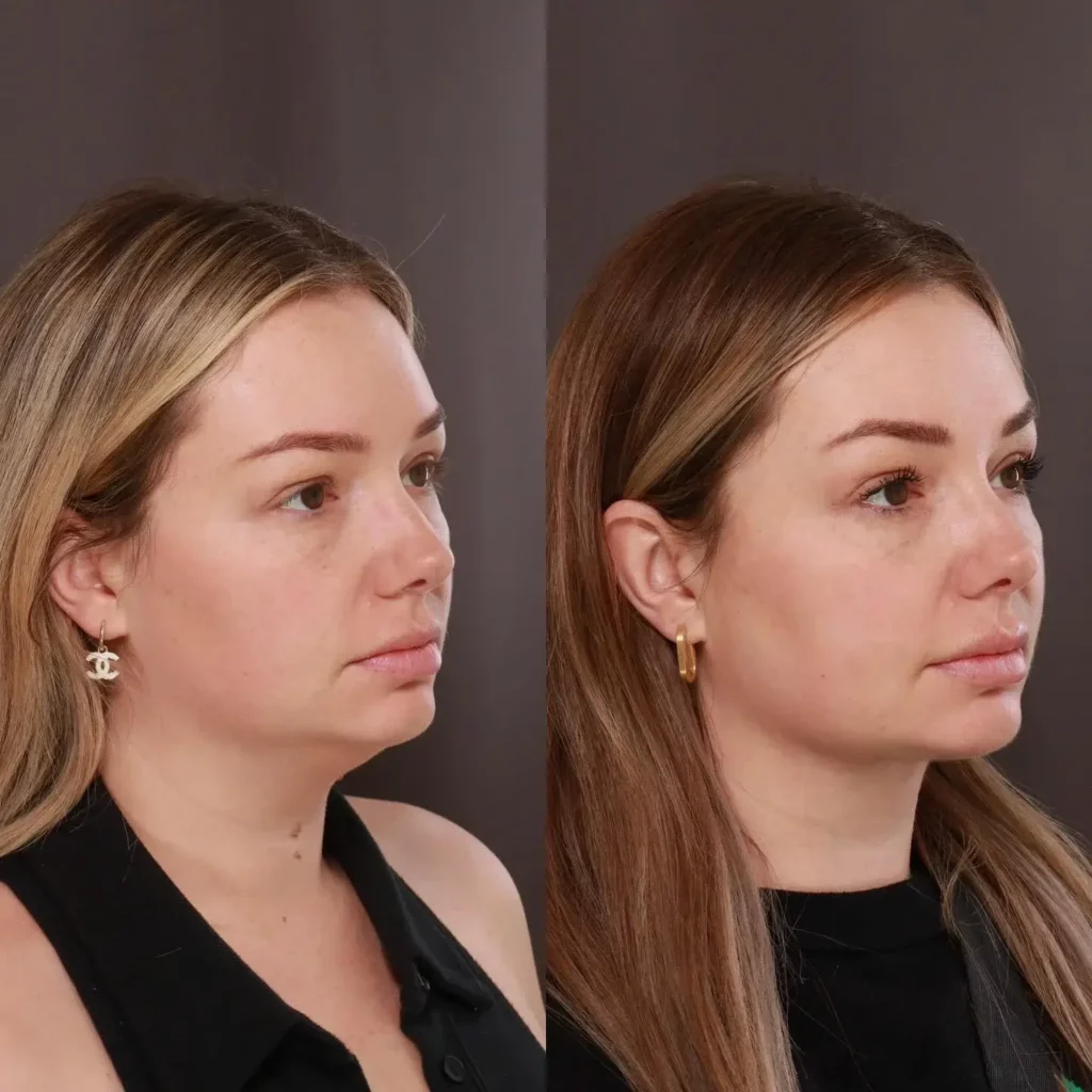 Neck Lift Before and After