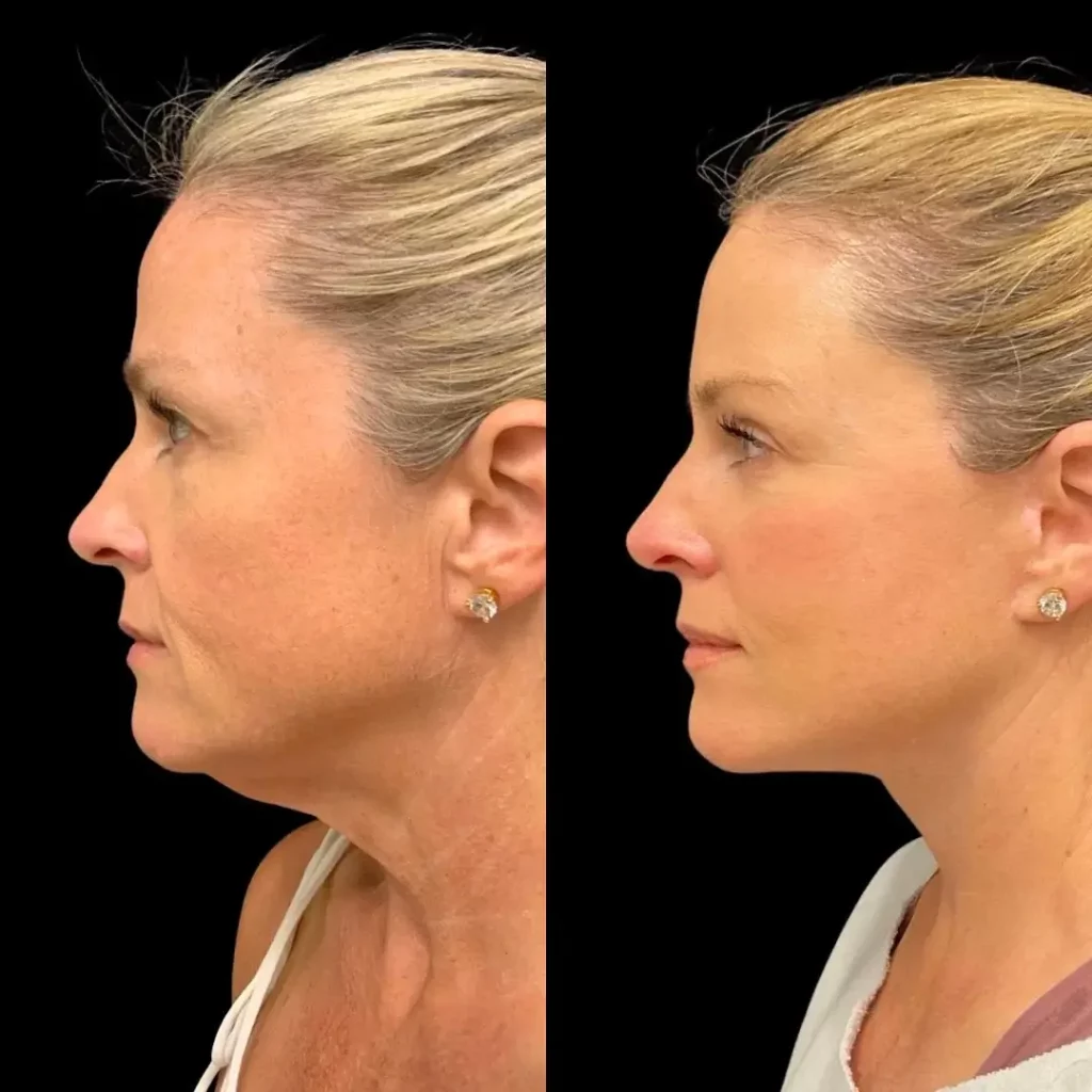 Neck Lift Before and After