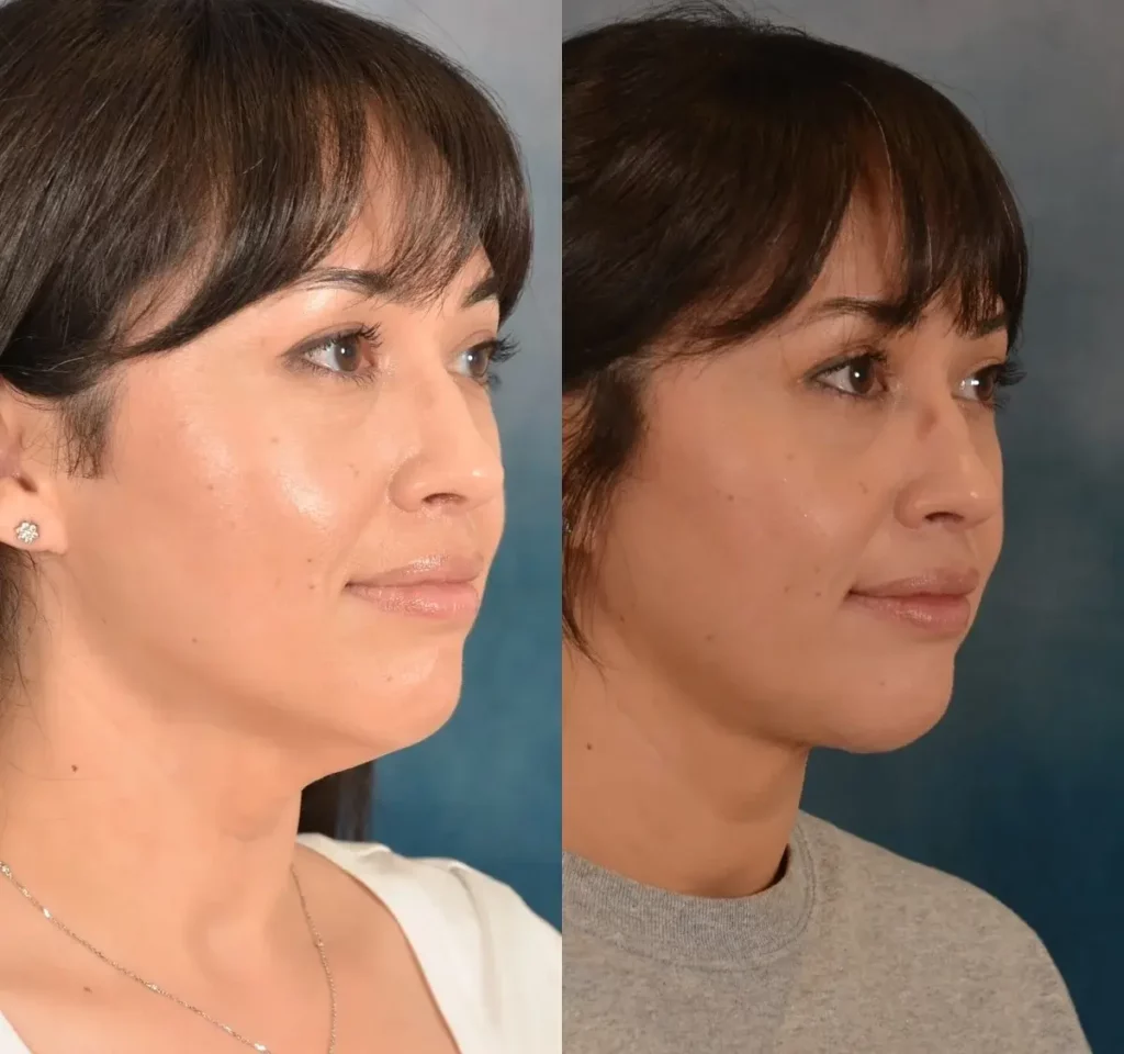 Neck Lift Before and After