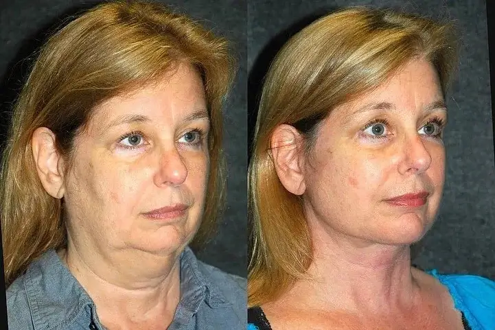 Neck Lift Before and After