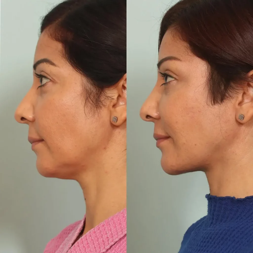 Neck Lift Before and After