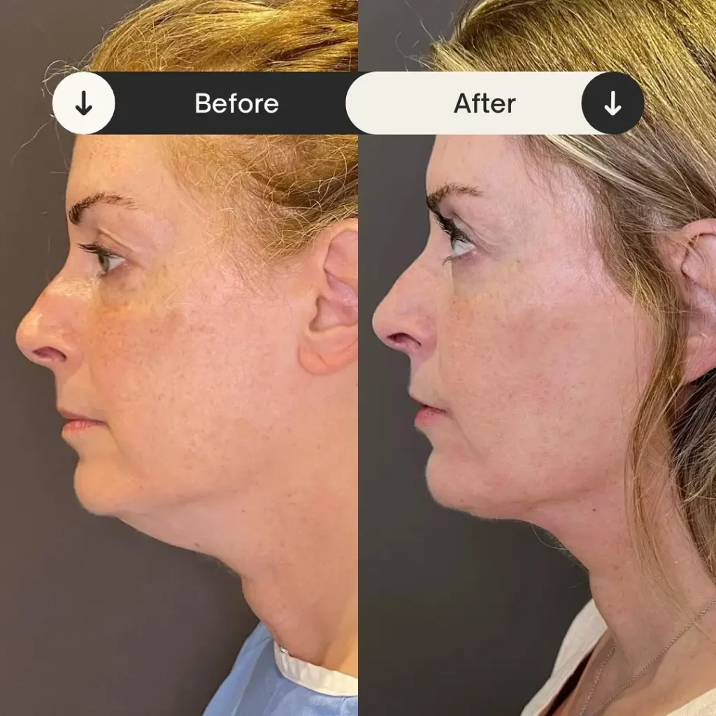 Neck Lift Before and After