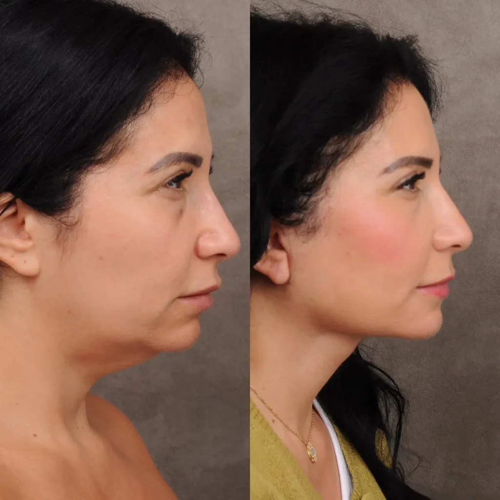 Neck Lift Before and After