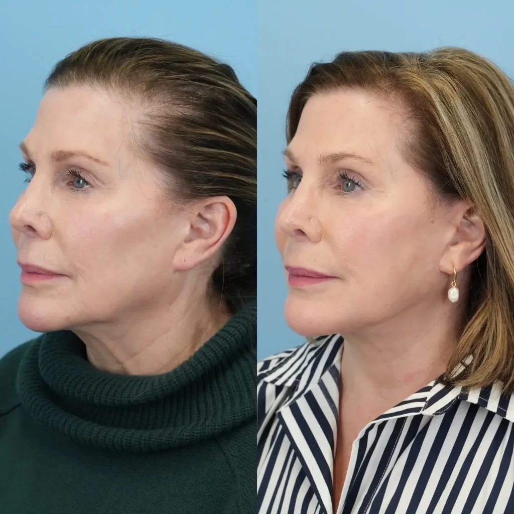 Neck Lift Before and After