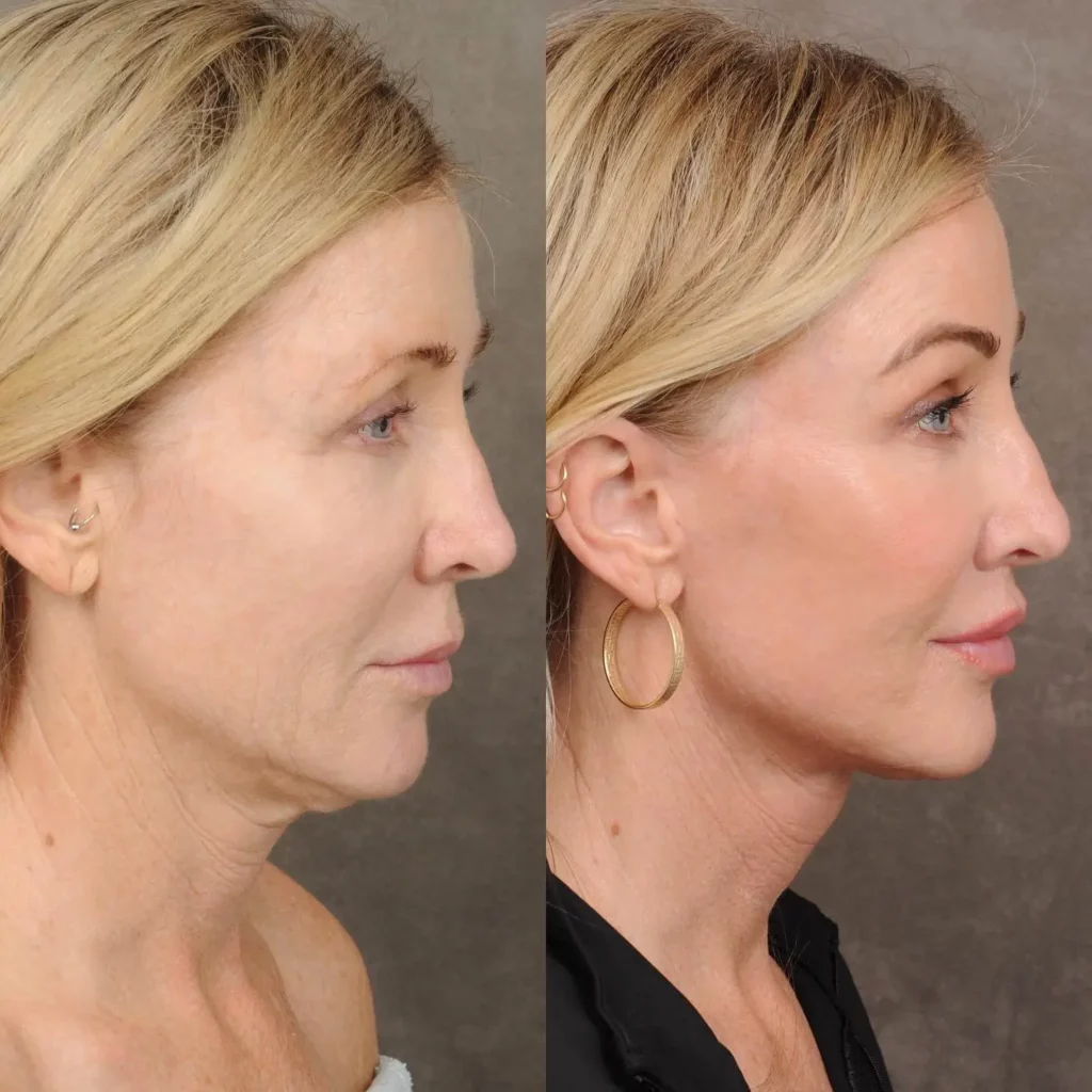 Neck Lift Before and After