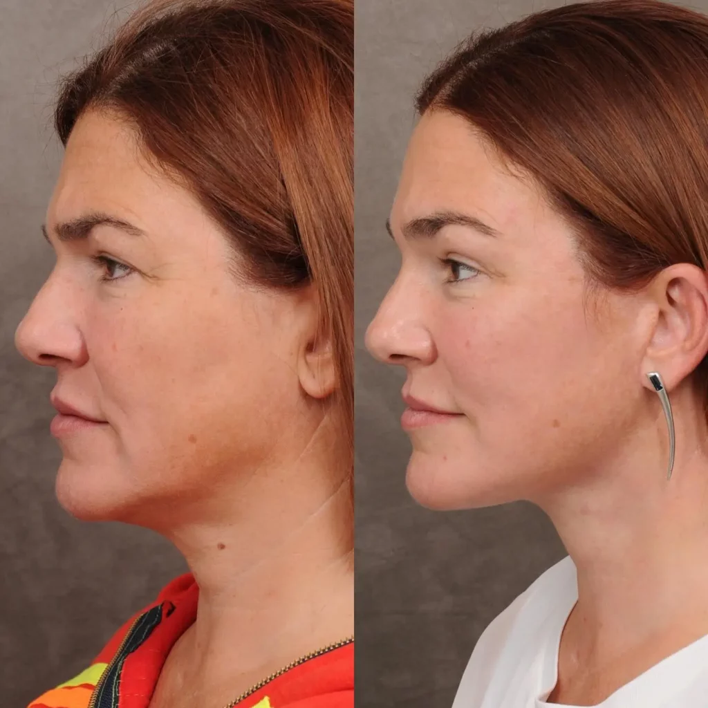 Neck Lift Before and After