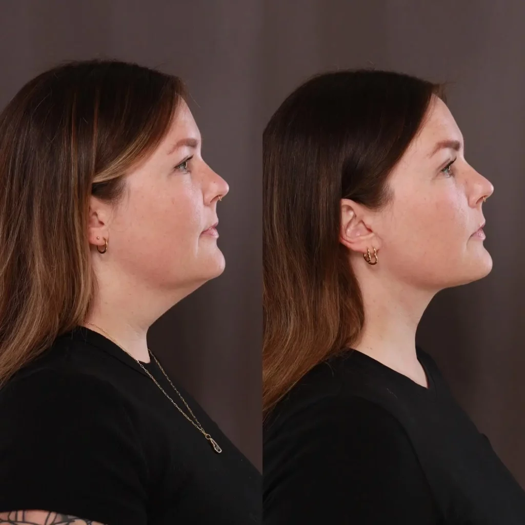 Neck Lift Before and After