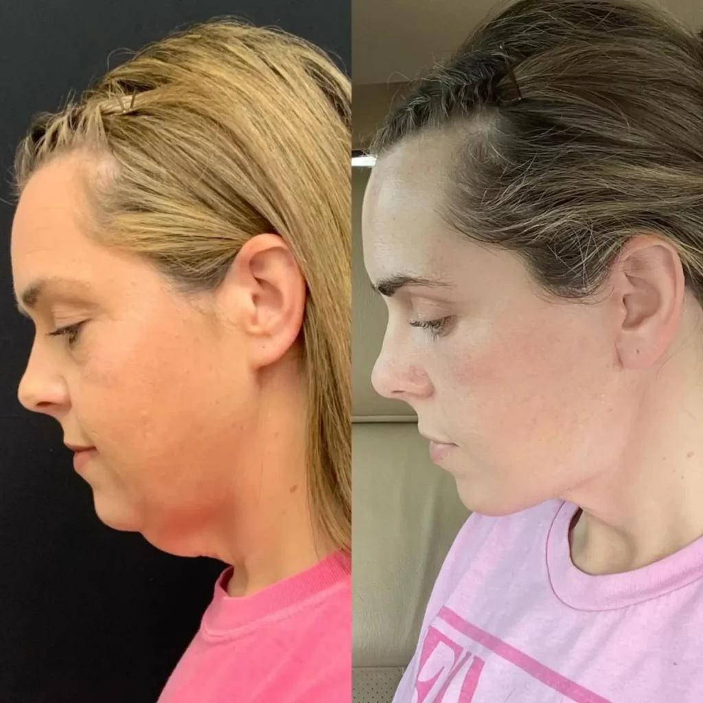 Neck Lift Before and After