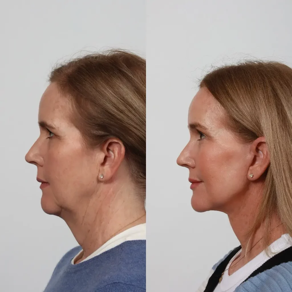 Neck Lift Before and After