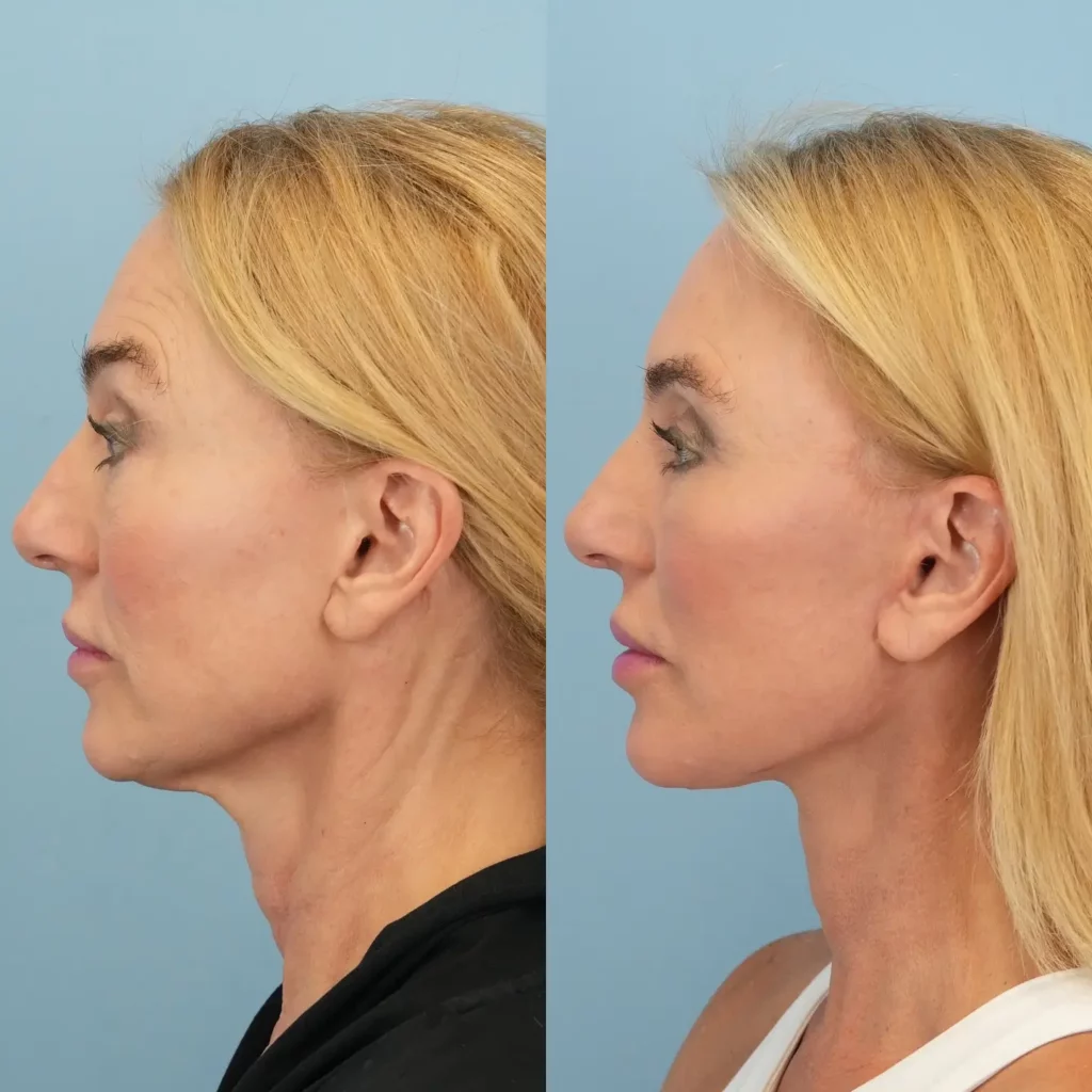 Neck Lift Before and After