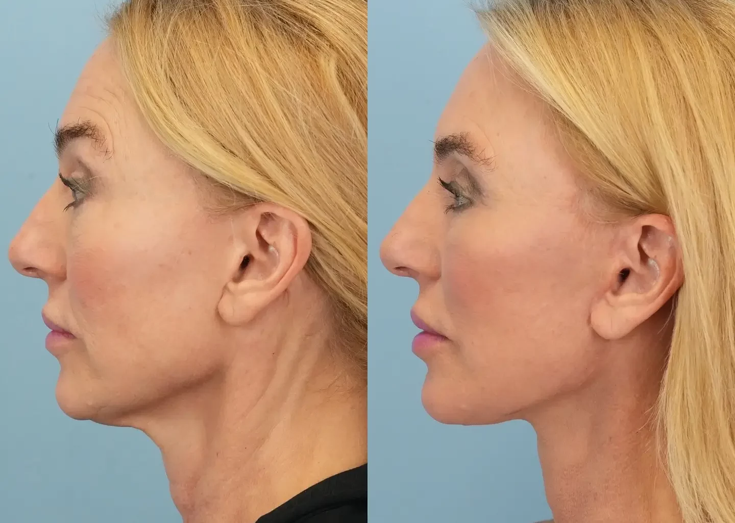 Neck Lift Before and After