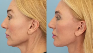 Neck Lift Before and After