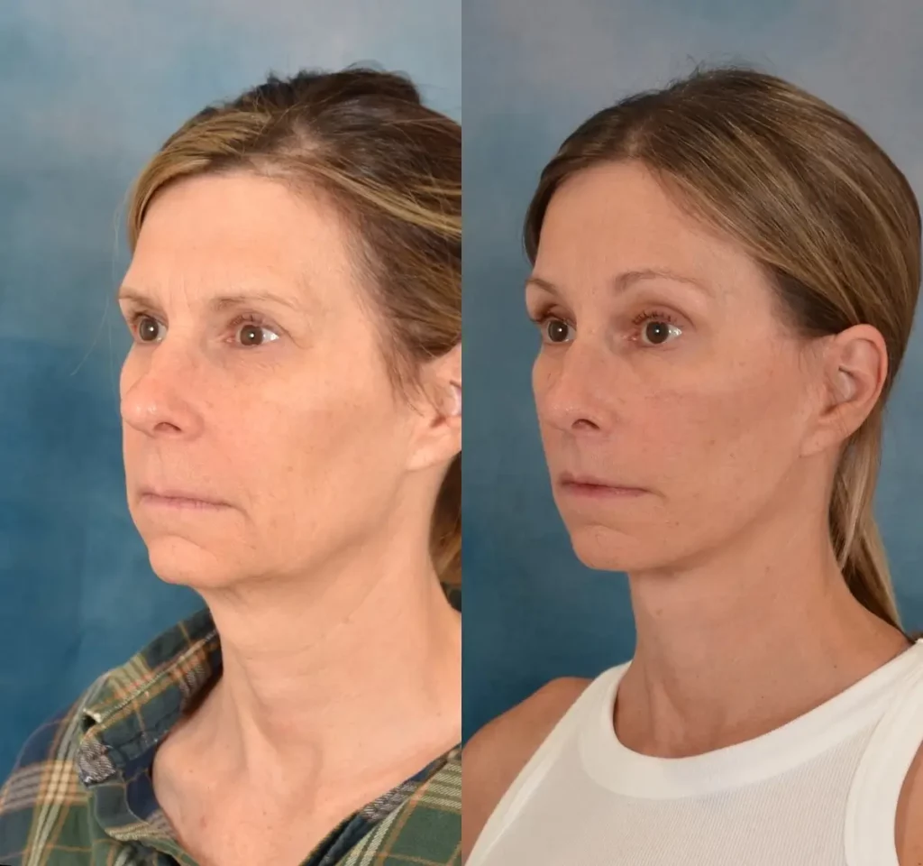 Neck Lift Before and After