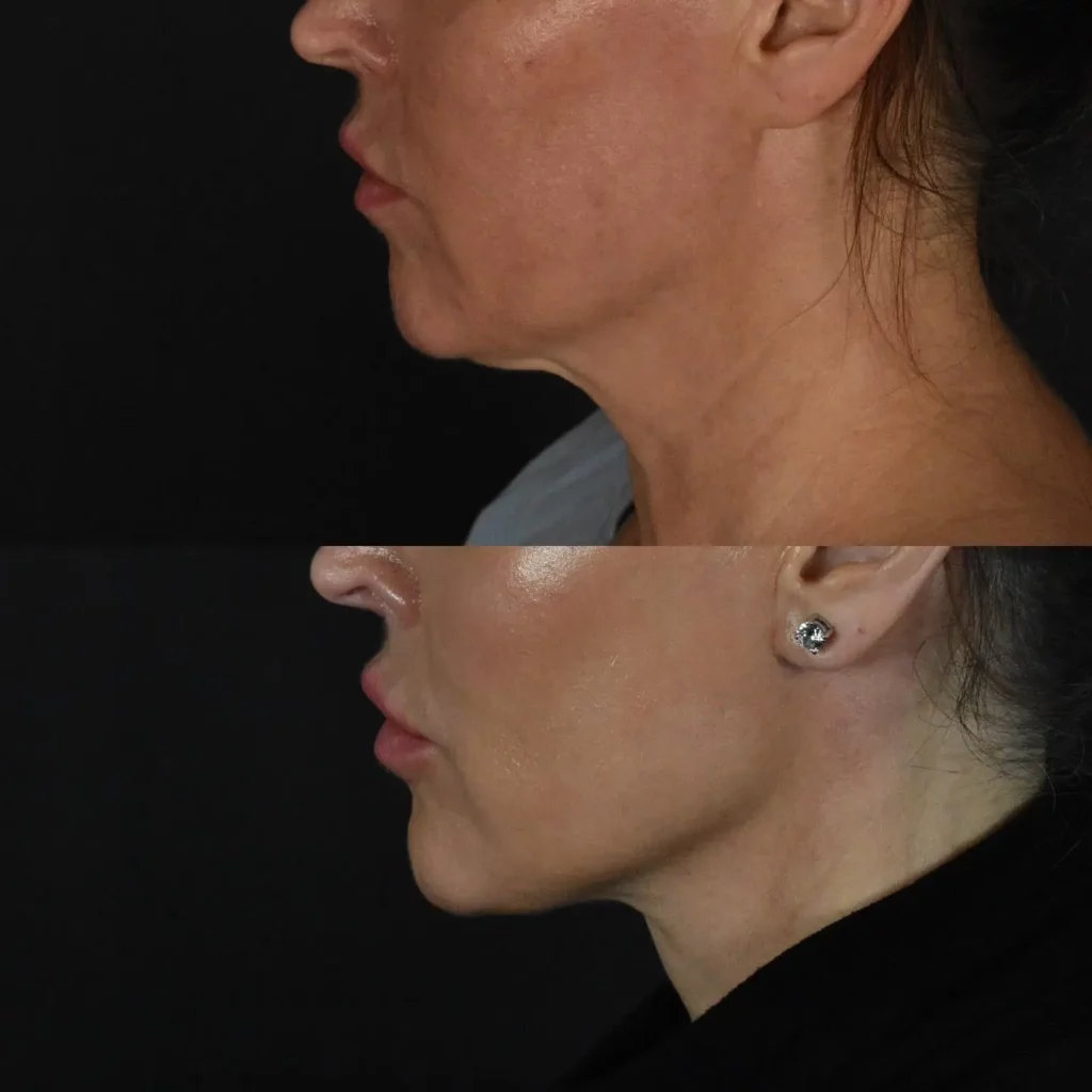 Neck Lift Before and After